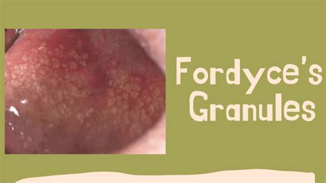 grain de fordyxe|Grains de Fordyce : faut